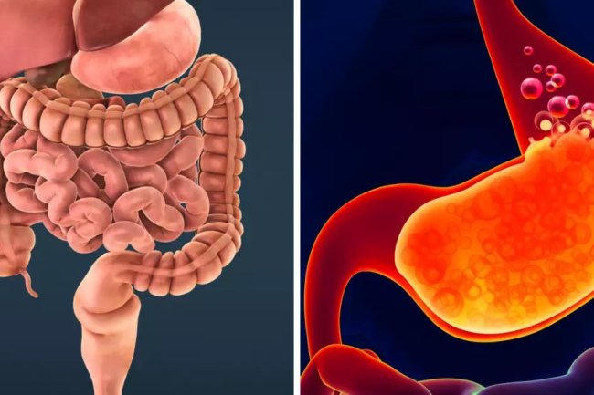 आंतों से जुड़ी गंभीर बीमारी है