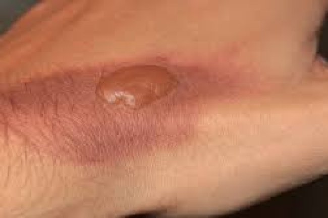 जलने पर गलती से भी न करें 6 काम