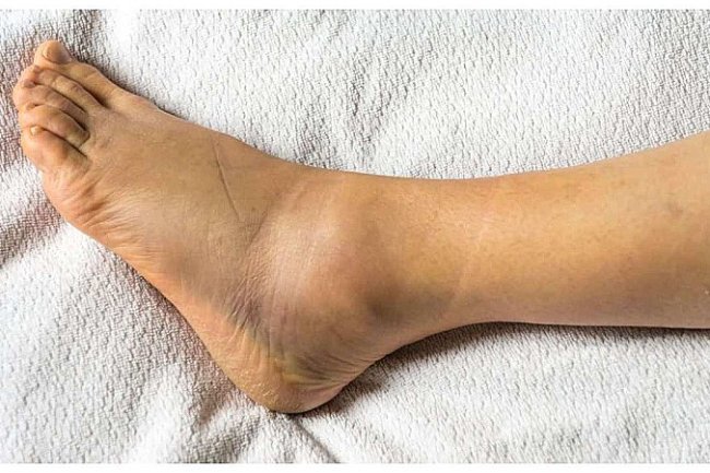 पांव में मोच आने के बाद क्या करें - क्‍या नहीं करना चाह‍िए